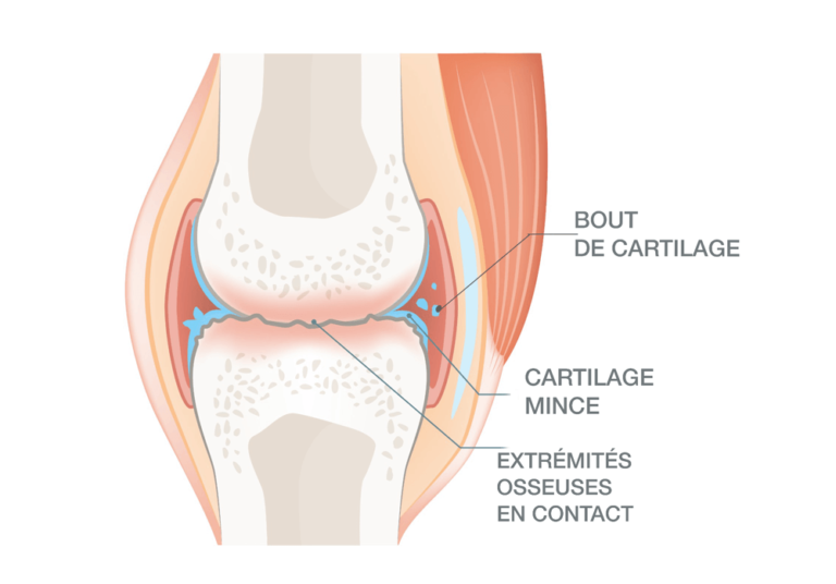 Comprendre la diff rence entre arthrite et arthrose facilement 
