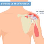 BURSITE : 5 façons de soulager la douleur naturellement