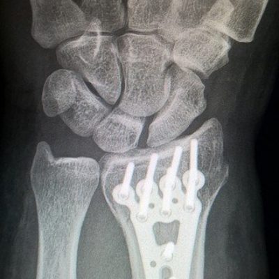Fracture du poignet : comment éviter une algodystrophie [SDRC] ?