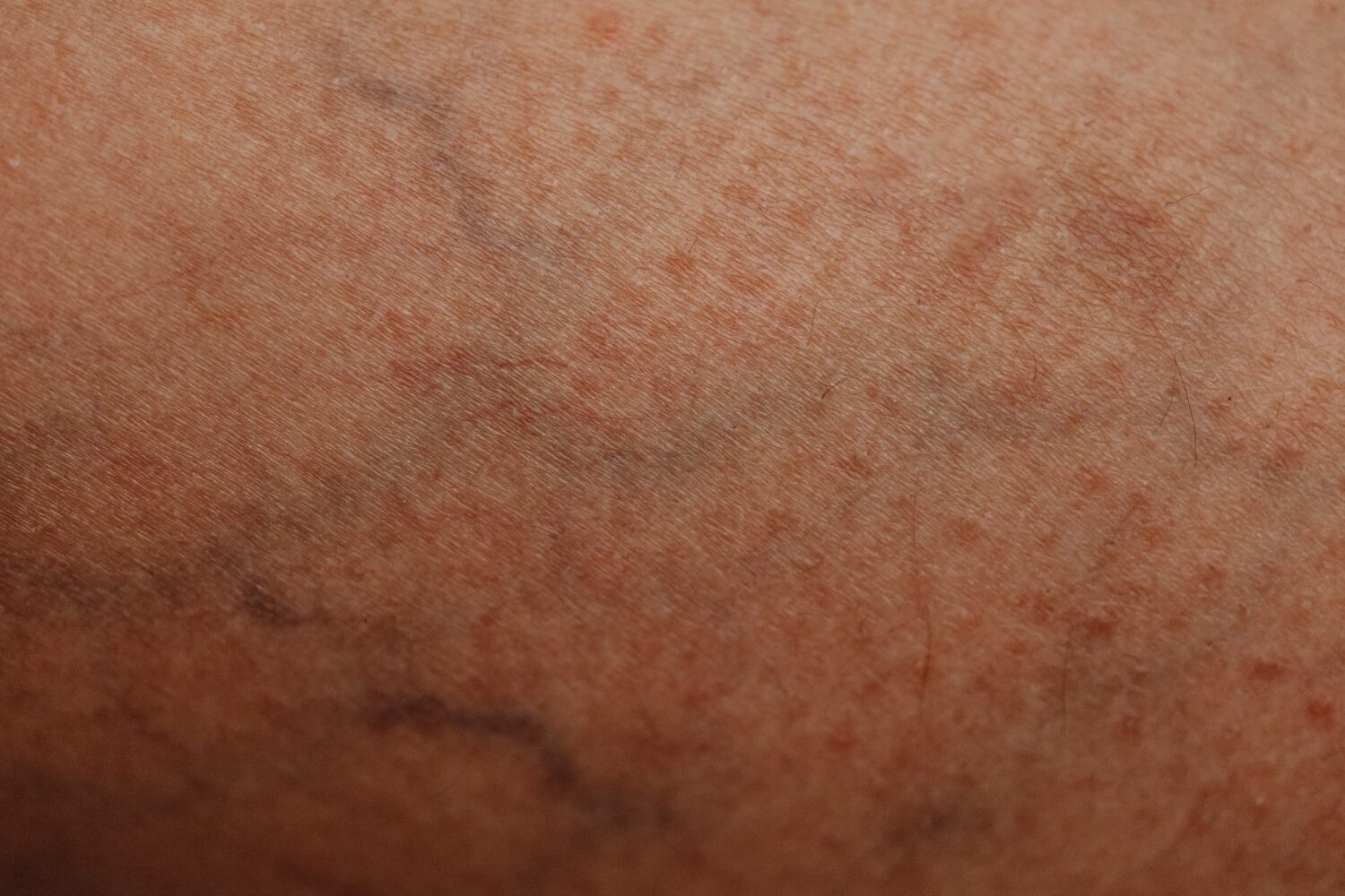 Tests Rapides pour Evaluer Varices et Jambes Lourdes en 10 Minutes ⏰