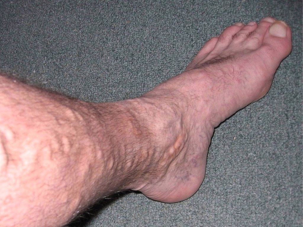 Tests Rapides pour Evaluer Varices et Jambes Lourdes en 10 Minutes ⏰
