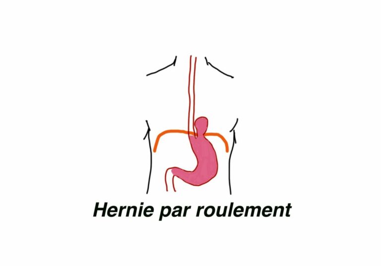 Hernie hiatale par roulement.